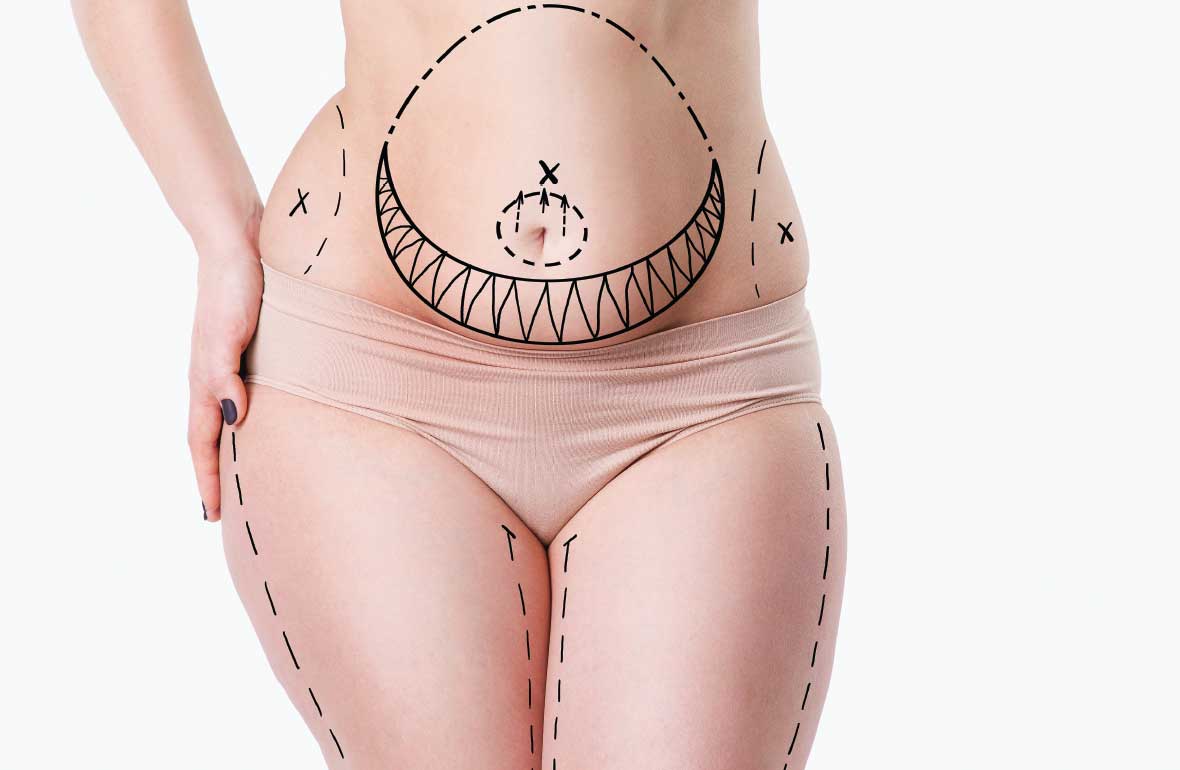 KARIN KOL BACAK GERME OPERASYONU SONRASI İZLER