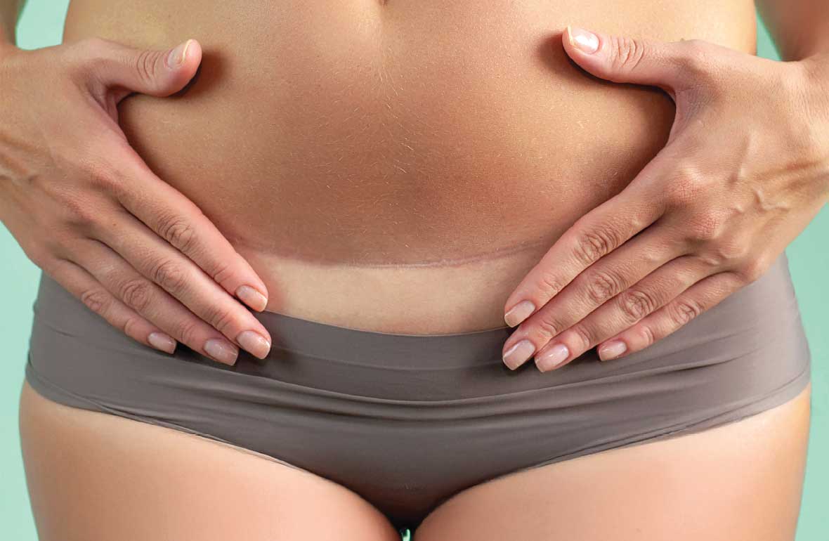 SEZARYEN DOĞUM SONRASI İZLER